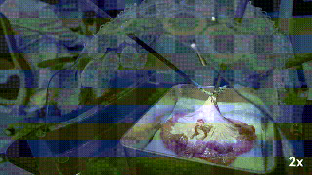 中国手术机器人里程碑式突破！Science子刊：全球首例临床场景下自主手术(图4)